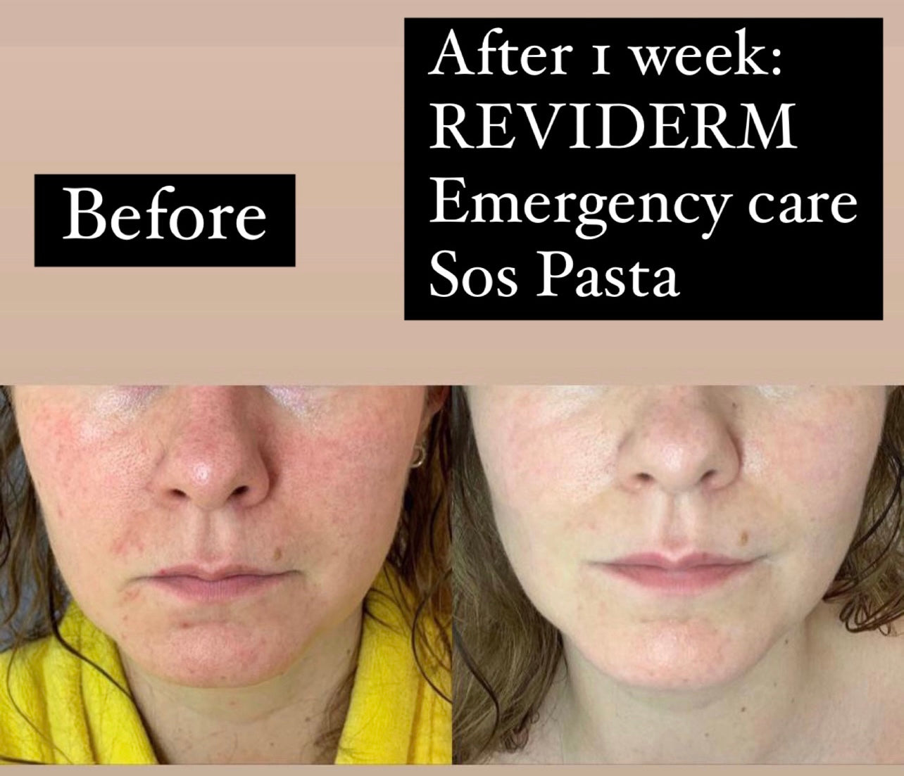 REVIDERM EMERGENCY CARE 10ml - SOS pasta akuuttiin ärsytykseen koko vartalolle ja kasvoille. Kortisoni