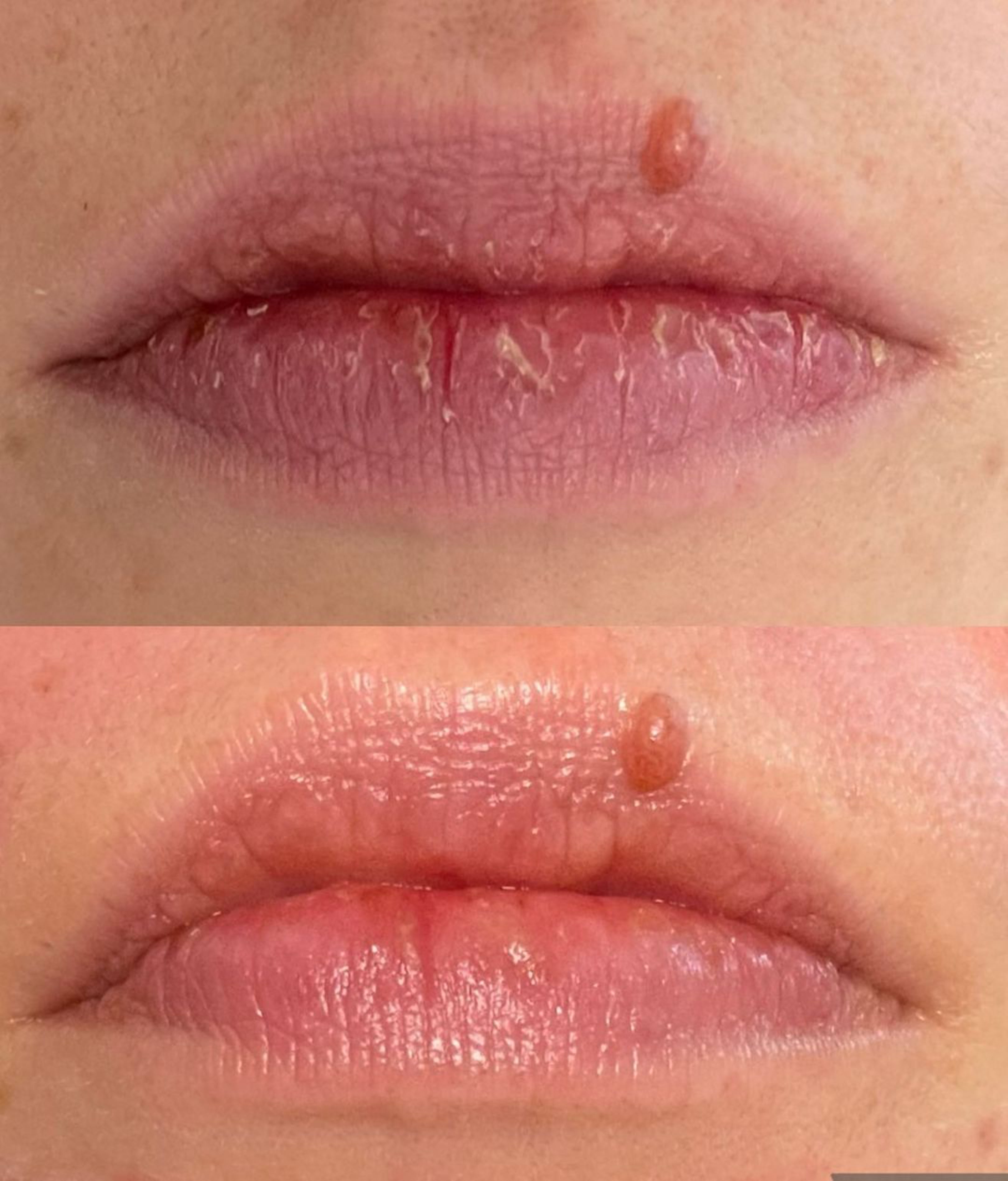 REVIDERM LIP PERFECTION PLUMPER – Tuplaa huulten oman hyaluronihappotuotannon. Loistava rohtuneille huulille ja täyttää juonteita.