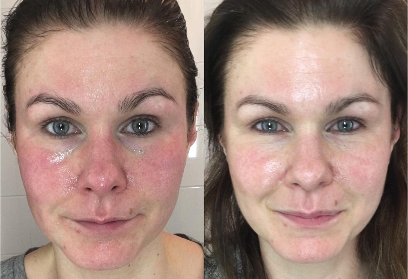 REVIDERM CALMING SILVER SPRAY – Ihoa nopeasti rauhoittava hopeasuihke 100ml