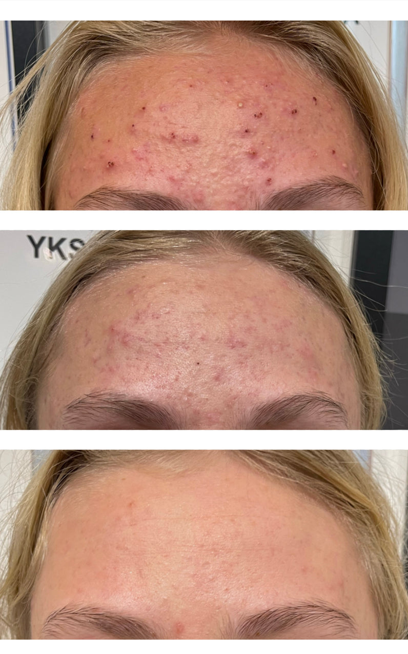 REVIDERM AHA GEL - Epäpuhtaan ihon hoitogeeli yöksi