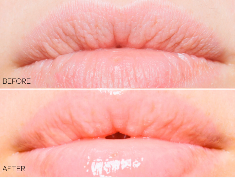 LIP SMART - HUULIVOIDE. Kuivat huulet. Huulirasva. LIPSMART®  on todistetusti tehokas ratkaisu kaikkiin kuiviin huuliin liittyviin ongelmiin.  Se täyttää huulesi sen tarvitsemilla ainesosilla lievittääkseen ja vähentääkseen kuivuutta, halkeamia, juonteita ja rohtuneisuutta.