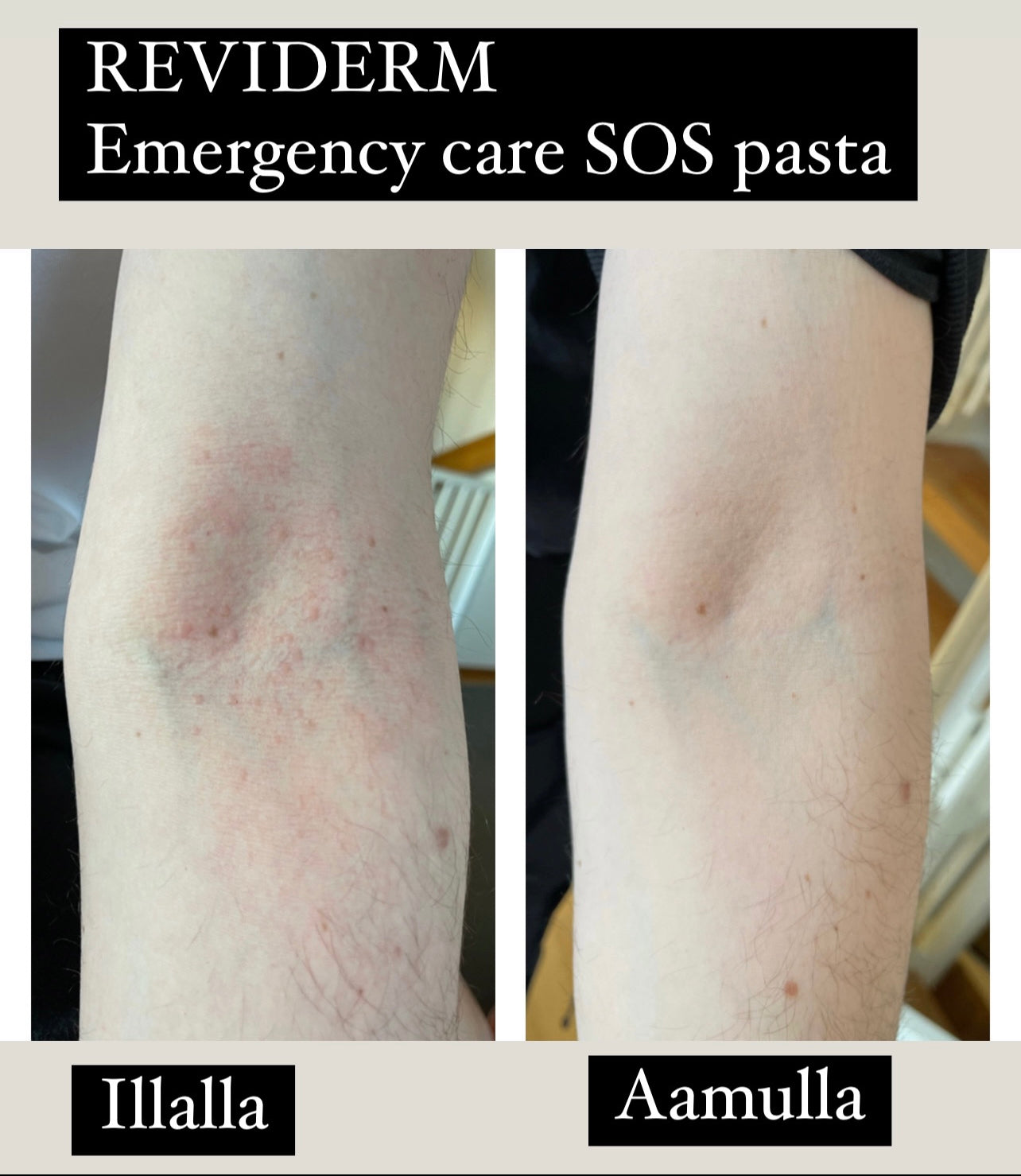 REVIDERM EMERGENCY CARE 10ml - SOS pasta akuuttiin ärsytykseen koko vartalolle ja kasvoille. Kortisoni
