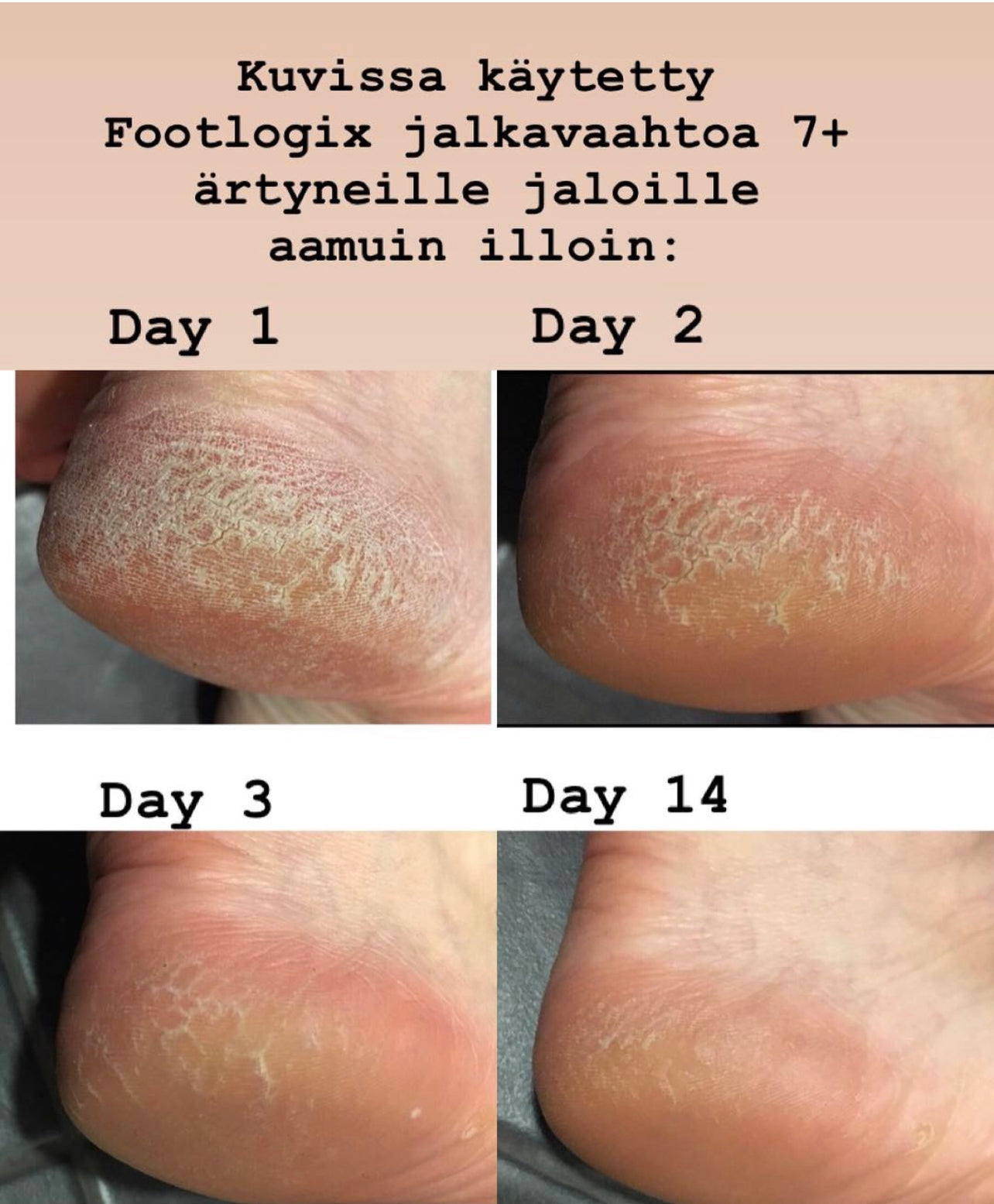 FOOTLOGIX 7+ Vaahtovoide ärtyneelle iholle